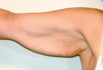 Brachioplasty (Arm Lift) After Massive Weight Loss (Front View)