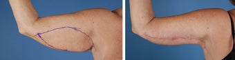 Arm Lift (Brachioplasty)