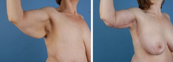 Arm lift (Brachioplasty)