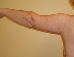 Arm LIft