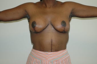 Arm Lift (brachioplasty)
