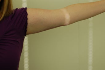 Arm Lift (brachioplasty)