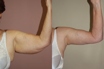 Arm Lift (Brachioplasty)