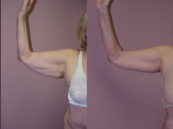Arm Lift