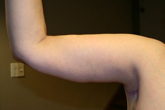 Brachioplasty - arm lift