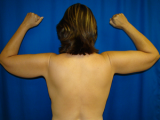 Arm Lift