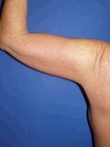 Arm Lift