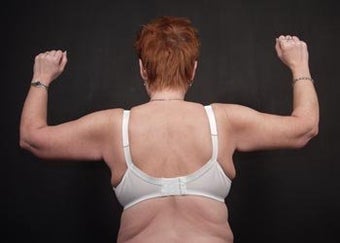 Brachioplasty (Arm Lift)