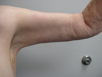 Arm Lift
