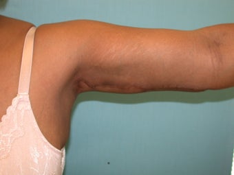 armlift