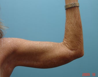 Full Extended Brachioplasty
