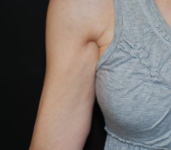VASER Shape to Arms