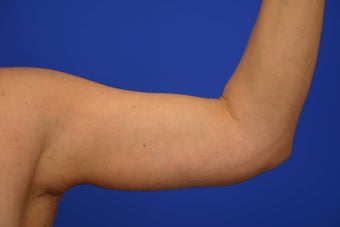 Arm lift