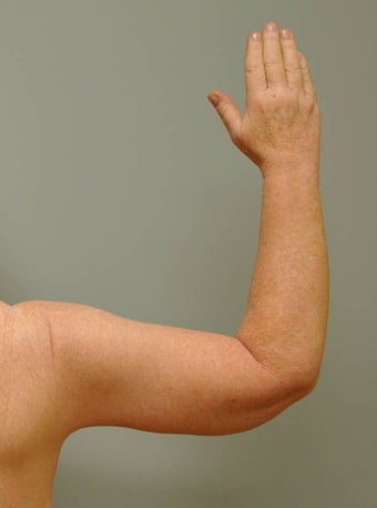Arm Lift (Brachioplasty)