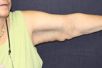 Brachioplasty (Arm Lift)