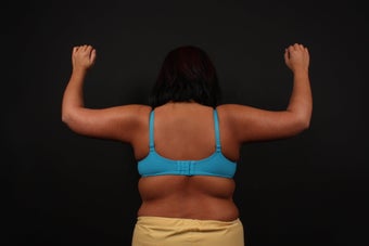 Arm Lift