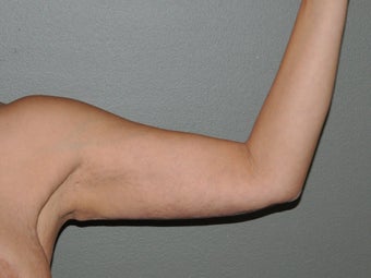 Arm Lift