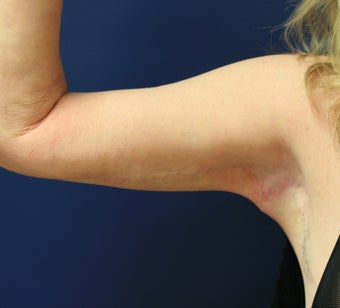Arm lift (brachioplasty)