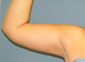 Brachioplasty