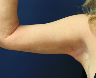 Arm lift