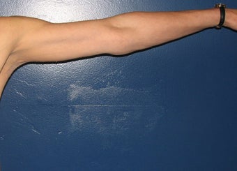Brachioplasty