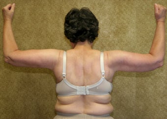 Brachioplasty or arm tuck in los angeles