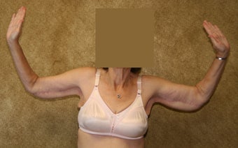 Brachioplasty or arm tuck in los angeles