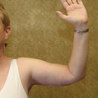 Brachioplasty or arm tuck