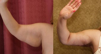 Brachioplasty or arm tuck in los angeles