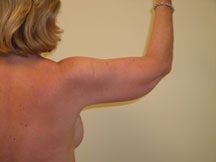 Arm Lift