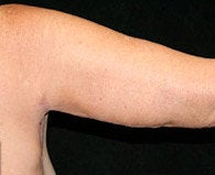 Arm Lift
