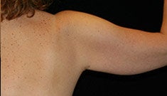 Arm Lift