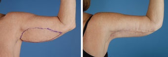 Arm Lift (Brachioplasty)