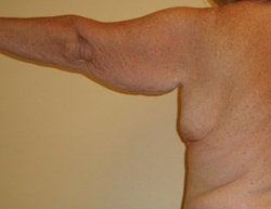 Arm LIft