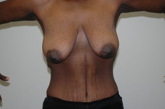 Arm Lift (brachioplasty)