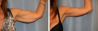 62 years old / brachioplasty, (arm lift)