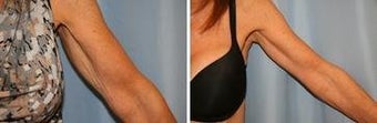 62 years old / brachioplasty, (arm lift)
