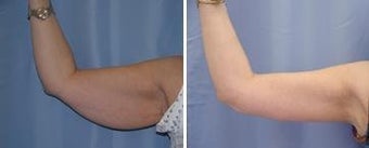 46 years old / brachioplasty (arm lift)