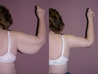 Arm Lift (Brachioplasty)