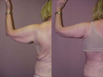 Arm Lift
