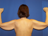 Arm Lift