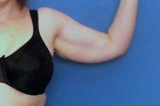 Brachioplasty