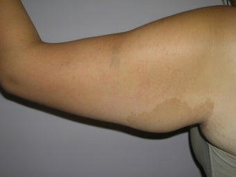 Arm Lift