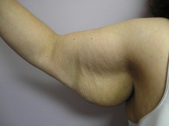 Arm Lift