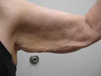 Arm Lift