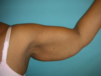 armlift