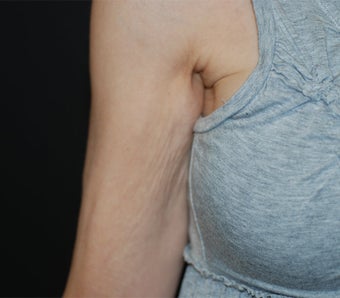 VASER Shape to Arms