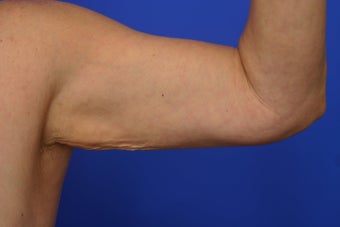 Arm lift