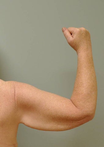 Arm Lift (Brachioplasty)