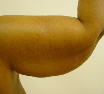 BRACHIOPLASTY (ARM LIFT)